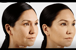 juvederm fillers clinic in islamabad
