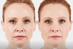 juvederm fillers in rawalpindi