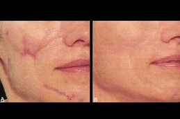 laser treatment good for your skin in rawalpindi
