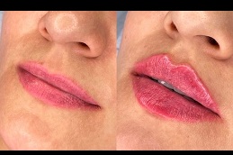russian lip fillers clinic in islamabad