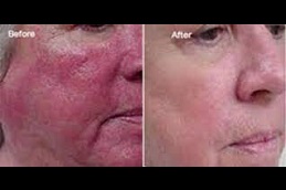 Best certified doctors for rosacea Clinic in islamabad