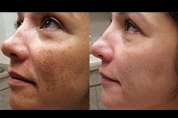 Best chemical peels for melasma Clinic in Islamabad