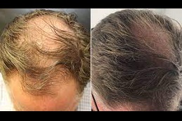 Best exosome hair treatment Clinic in islamabad