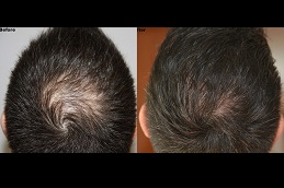 Best exosome hair treatment in rawalpindi