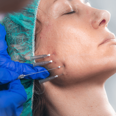 PDO Thread Lift for Chin Lift in Islamabad & Pakistan Price & Cost