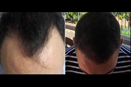 best latest technology for hair transplant in islamabad