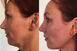 best pdo thread lift for chin lift in islamabad