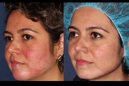 certified doctors for rosacea Clinic in islamabad