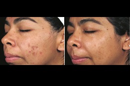 deep cleansing facial cost in rawalpindi