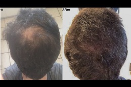 exosome hair treatment in islamabad