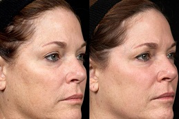 laser treatment for face cost Clinic in islamabad