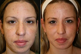  laser-treatment-for-face-cost-in-islamabad