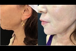 pdo thread lift for chin lift in islamabad
