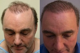 Best everything you need to know about hair transplantation Clinic in islamabad