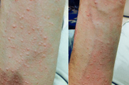 Best hives treatment cost Clinic in islamabad