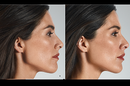 Best juvederm filler price Clinic in islamabad