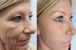 Best prp treatment for full face in rawalpindi