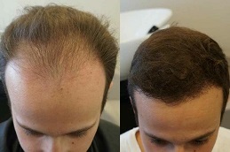 Best the different techniques of hair transplantation in rawalpindi