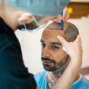 Everything You Need to Know About Hair Transplantation