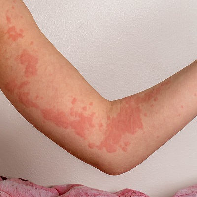 Hives Treatment Cost in Islamabad Pakistan