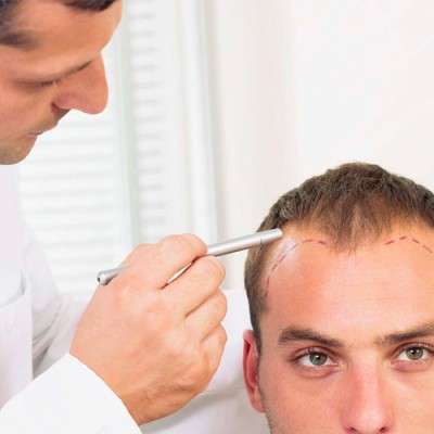 How to Choose the Right Hair Transplant Surgeon
