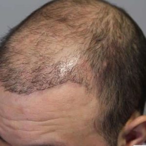 The Costs of Hair Transplantation: Is It Worth It?