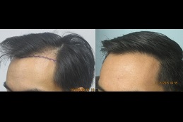 best hair transplant for diabetic patients in islamabad