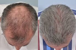 best the pros and cons of hair transplant surgery in islamabad