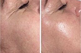 facial treatment for glowing skin in rawalpindi