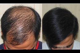hair transplant for diabetic patients in islamabad