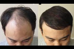 the different techniques of hair transplantation Clinic in islamabad