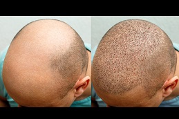 What would be a better option, a hair transplant or a non surgical hair  replacement? What are the pros and cons of both? - Quora
