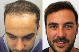what to expect during and after your hair transplant Clinic in islamabad