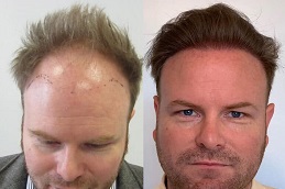 what to expect during and after your hair transplant in rawalpindi