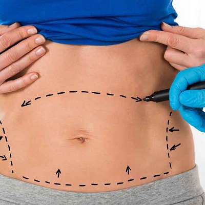 Liposuction Surgery Cost in Islamabad, Rawalpindi & Pakistan Price