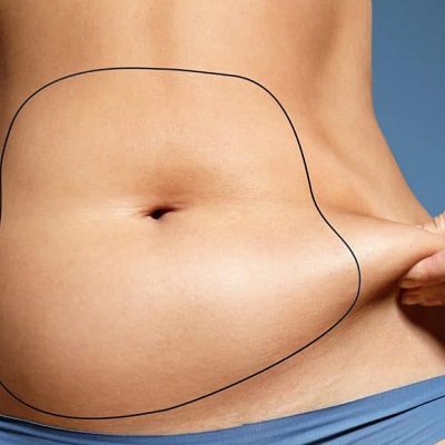 Liposuction Treatment for Abdomen Area in Islamabad & Pakistan Cost