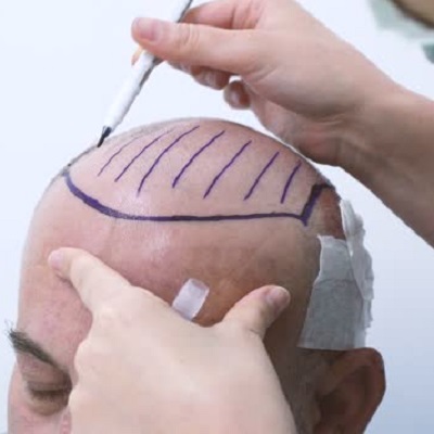 Side Effects of Hair Transplant Surgery in Islamabad & Pakistan Cost