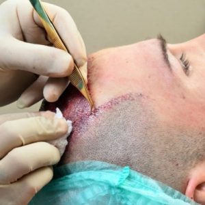 What Happens After A Hair Transplant Surgery?