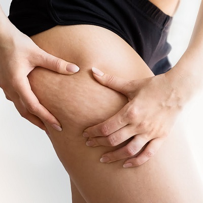 Does Liposuction Actually Remove Cellulite From Your Body in Islamabad