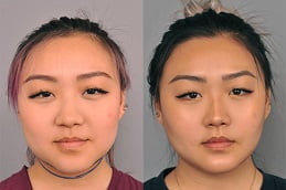 Best Buccal Fat Removal Treatment in Islamabad