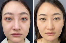 Best Clinic of Buccal Fat Removal Treatment Islamabad