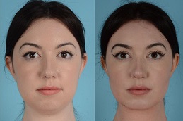 Best Clinic of Buccal Fat Removal Treatment in Islamabad