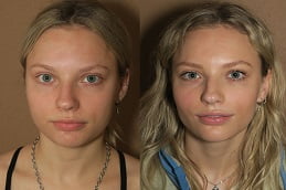 Buccal Fat Removal Treatment in Islamabad