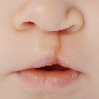 Cleft Lip And Palate Surgery Islamabad, Pakistan Cost & Price