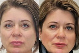 Sunekos Injections Treatment Islamabad