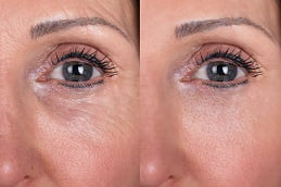Sunekos Injections Treatment in Islamabad