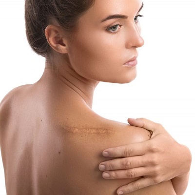 Surgical Scar Revision Cost in Islamabad Cost & Price