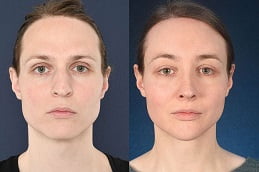 Best Chin Reduction Treatment Islamabad