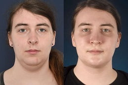 Best Chin Reduction Treatment in Islamabad