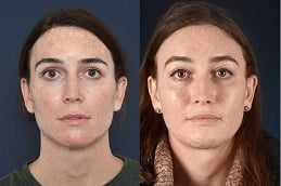 Best Clinic of Chin Reduction Treatment in Islamabad
